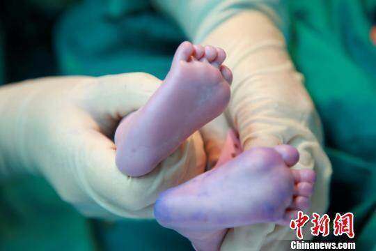 剖腹产婴儿