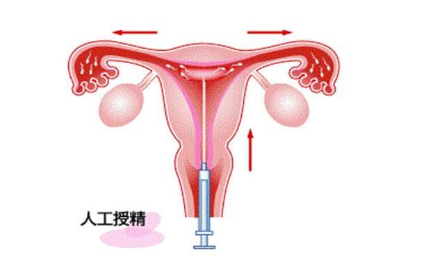 剖腹产