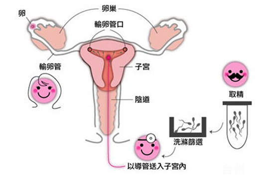 医疗性流产